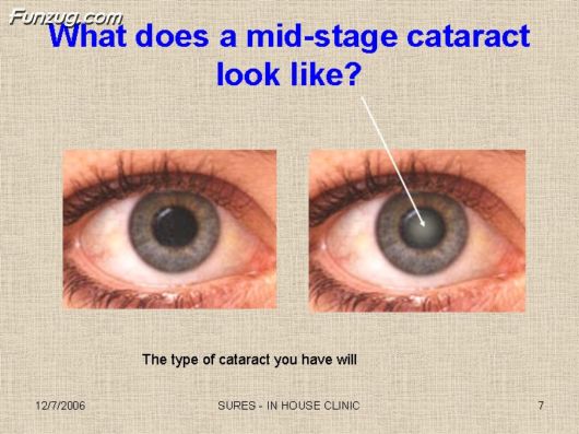 Very Useful Information on Cataract