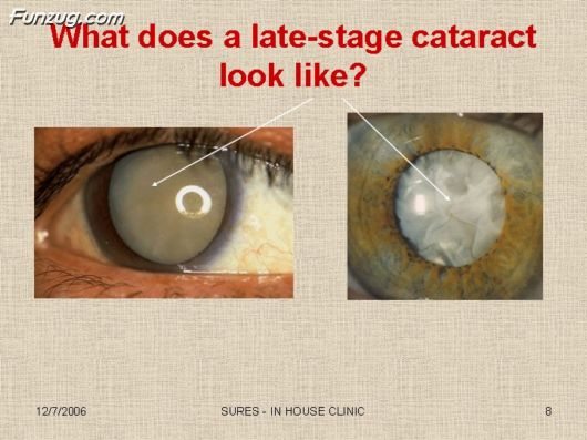 Very Useful Information on Cataract