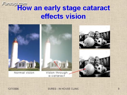 Very Useful Information on Cataract