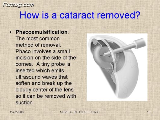 Very Useful Information on Cataract