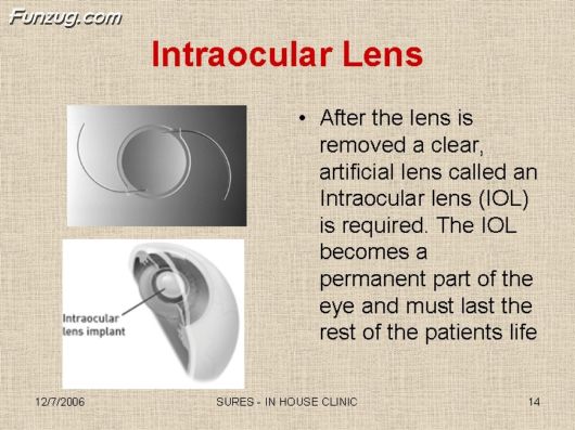 Very Useful Information on Cataract
