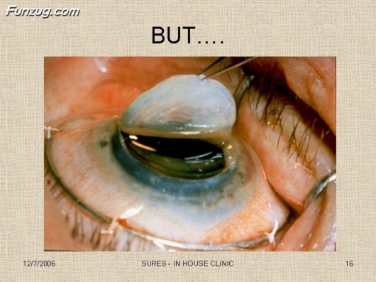 Very Useful Information on Cataract
